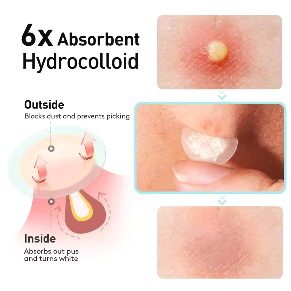 360 pieces/box acne patches -  - Face Oil review and price